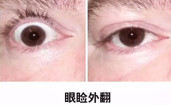 醫(yī)美技術越來越發(fā)達，不少愛美的人本著變美的心情滿懷期待地去做雙眼皮、開眼角等項目，不料整容不成、反倒毀容，后悔也來不及。有些做雙眼皮的姑娘術后出現(xiàn)眼瞼外翻的情況，那眼瞼外翻是什么意思?上眼瞼外翻如何修復?