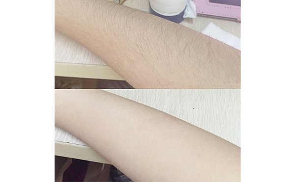 光子手臂脫毛效果怎么樣？