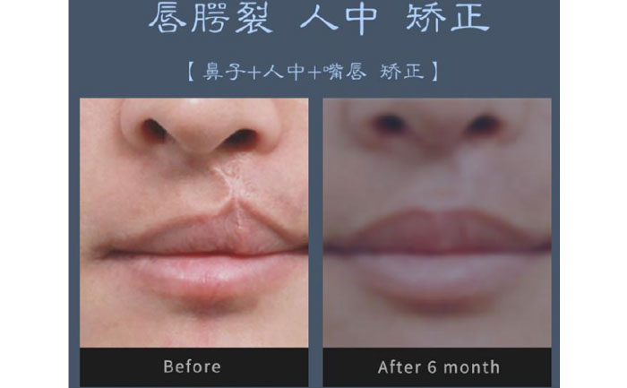 唇裂修復(fù)術(shù)需要多少錢？