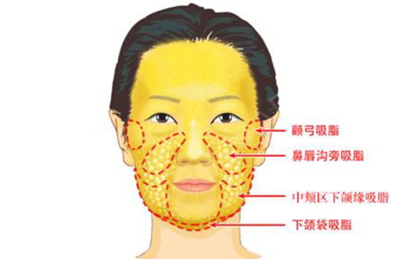 面部吸脂有哪些部位？
