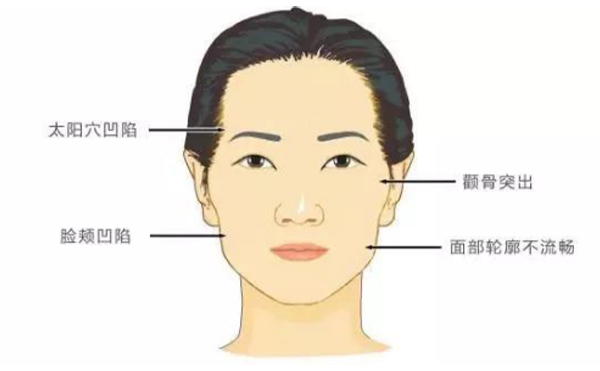 顴骨高或顴骨外擴應(yīng)該怎么辦?