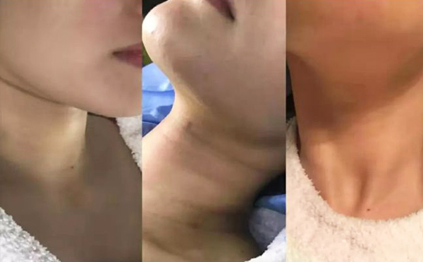 激光去頸紋多少錢？