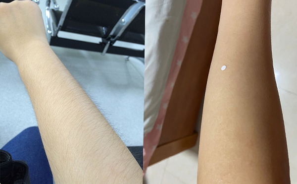 激光手臂脫毛價(jià)格貴不貴？