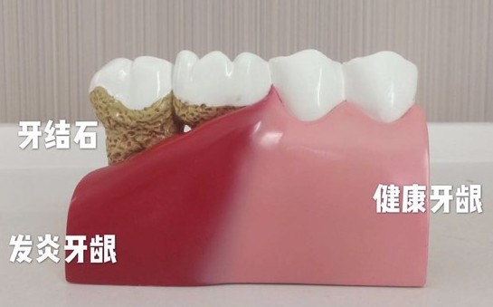 洗完牙后牙齒會(huì)變得敏感？