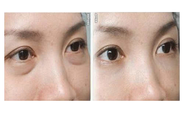 吸脂去眼袋有什么優(yōu)勢？