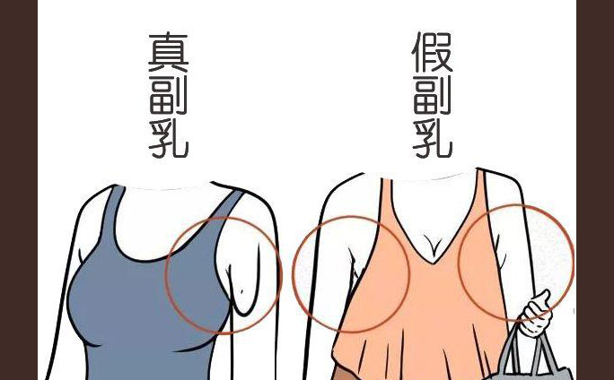多乳癥是什么癥狀？