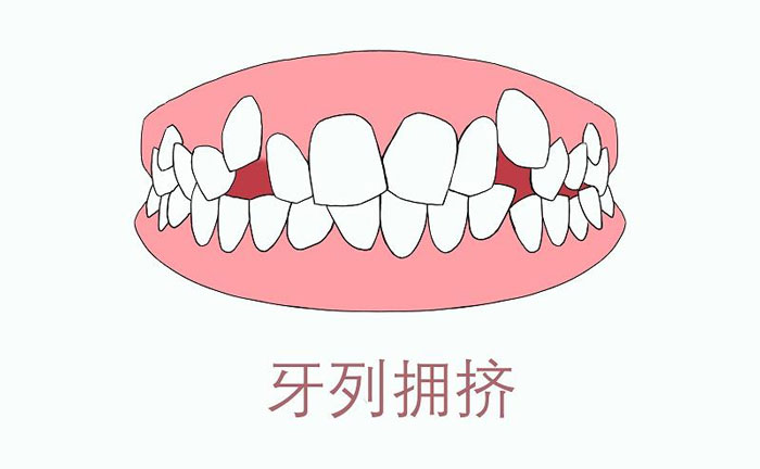 矯正牙齒擁擠度怎么算？