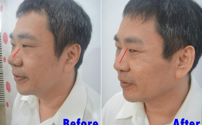 男性隆鼻子大概多少錢？