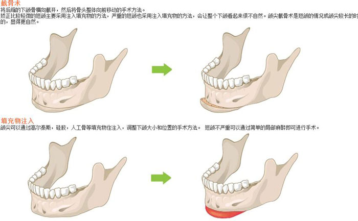 下頜角切除術(shù)一般多少錢？下頜角切除有后遺癥嗎？