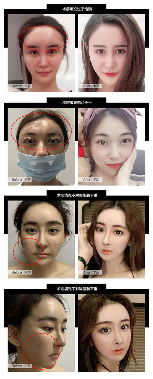 脂肪填充手術效果對比圖
