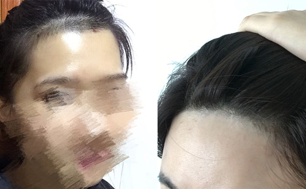 冰點面部脫毛有沒有疼痛感？