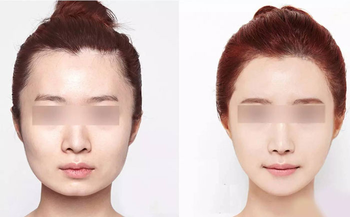 臉部咬肌肥大怎么瘦？臉部咬肌肥大如何去除？