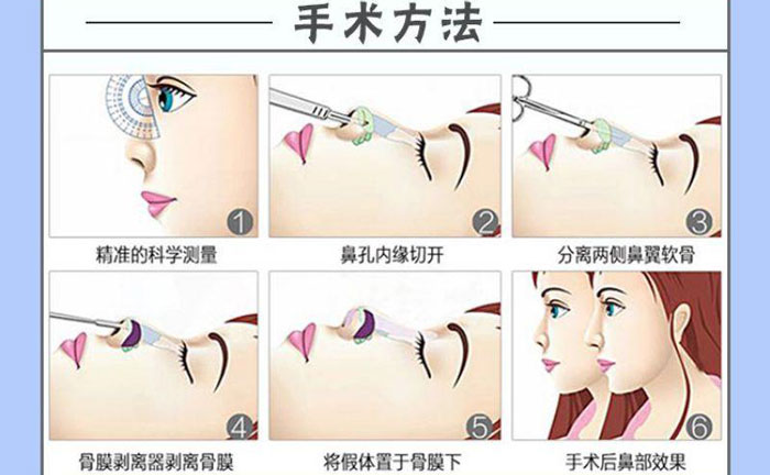 隆鼻假體取出后能恢復(fù)到以前嗎？