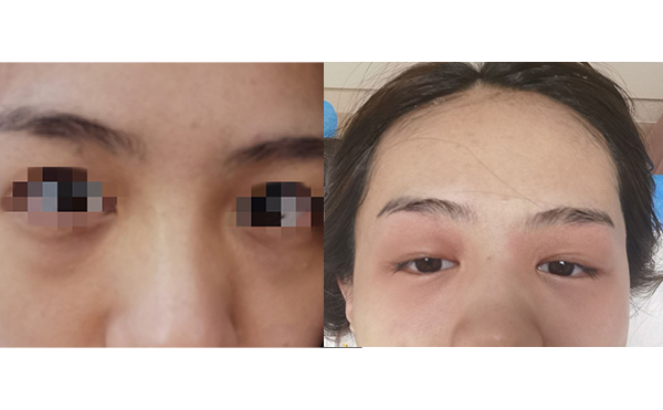 光子嫩膚去黑眼圈怎么樣？