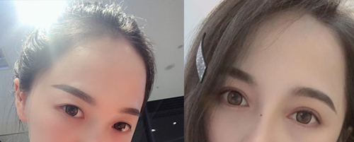 蘭州亞韓做雙眼皮案例對(duì)比圖1