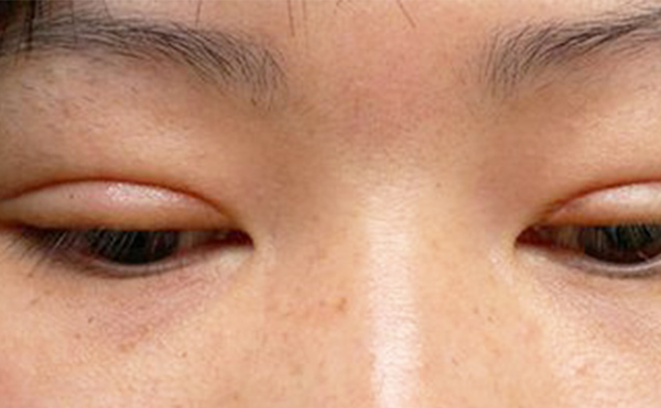 埋線雙眼皮失敗該如何修復(fù)？多久修復(fù)好？