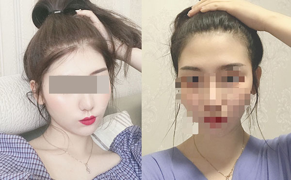 冰點(diǎn)脫毛后多久可以洗澡嗎？