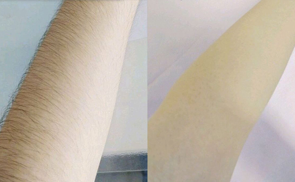 光子脫毛有疼痛感嗎？