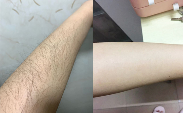 光子手臂脫毛是怎么做的？