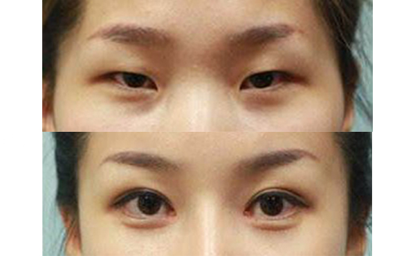 眼綜合手術(shù)多久能恢復(fù)自然？