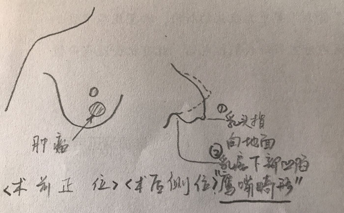 乳房畸形是什么原因造成的？乳房畸形矯正手術方法？
