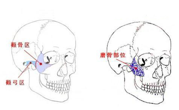 顴骨整形一般是從哪里切口？