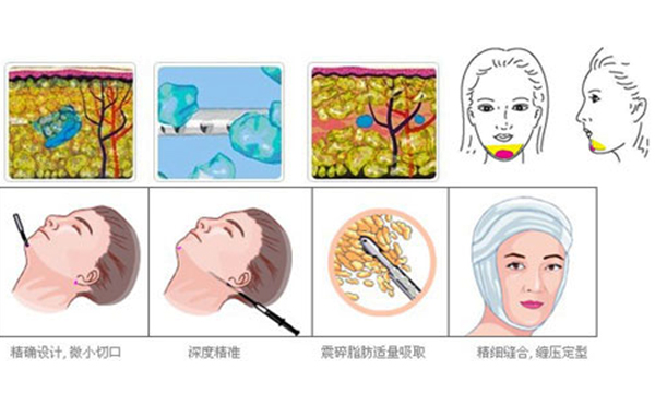 下巴整形吸脂術(shù)要多少錢？