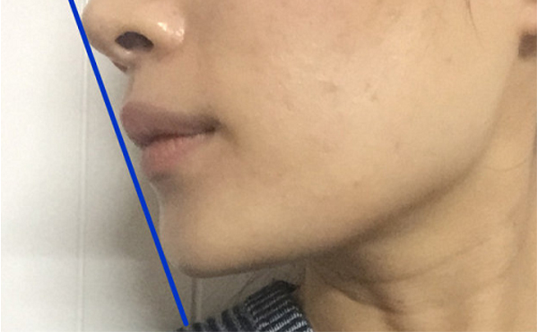 做假體墊下巴恢復(fù)后會被摸出來做過嗎？還能打玻尿酸嗎？