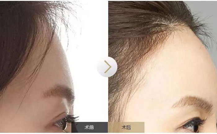 額頭填充術(shù)可以保持多久？