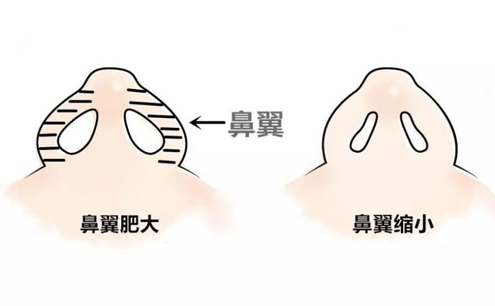 鼻翼縮小手術要做多久？