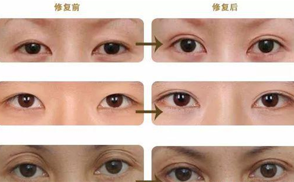 雙眼皮修復(fù)可靠嗎？什么時(shí)候做雙眼皮修復(fù)比較好？