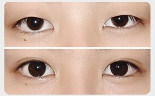 割雙眼皮和開(kāi)眼角可以同時(shí)進(jìn)行嗎?一共多少錢?