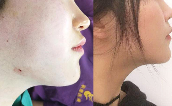 面部吸脂恢復(fù)期多長時(shí)間？