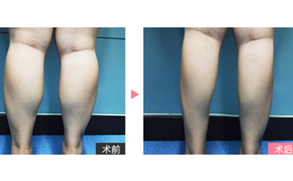 boxo瘦腿有什么優(yōu)勢？