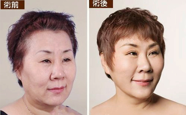拉皮手術(shù)多久能恢復自然？