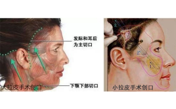 小拉皮和傳統(tǒng)拉皮有什么區(qū)別？
