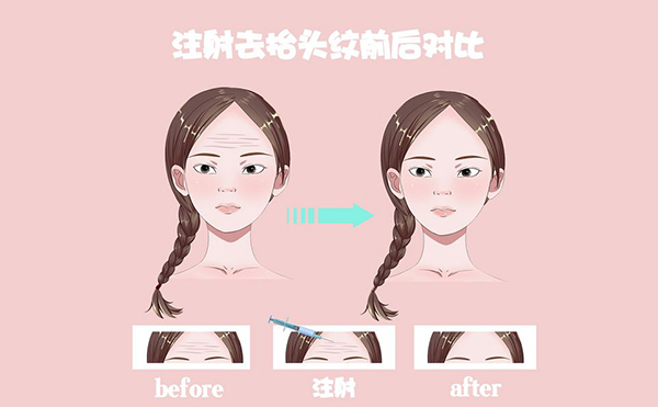電波拉皮怎么去除抬頭紋？