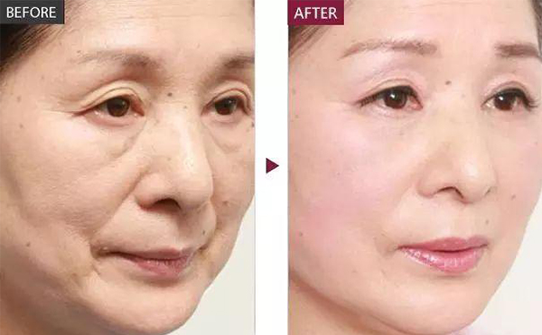 膠原蛋白除皺的適應(yīng)人群？