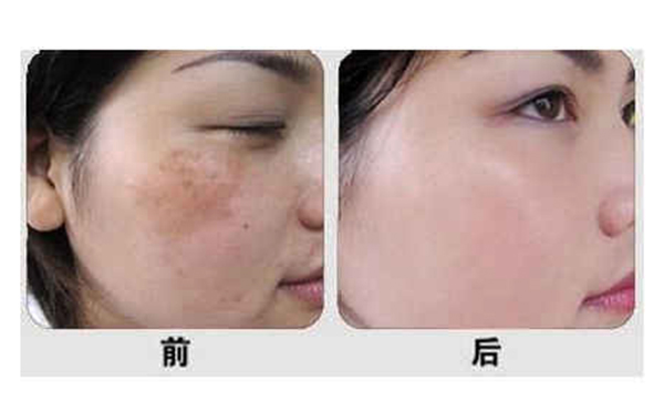 光子嫩膚有什么優(yōu)勢(shì)？