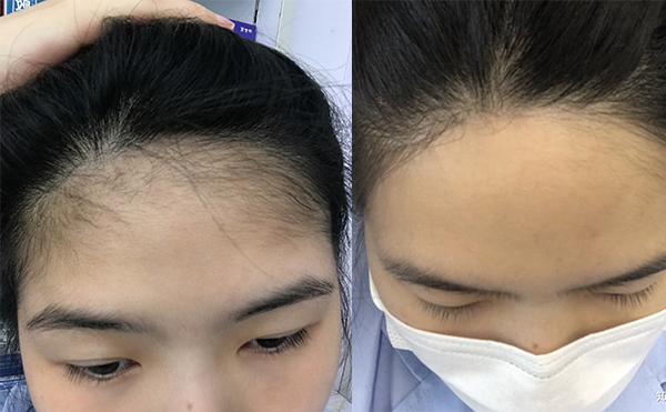 激光脫發(fā)際線的過(guò)程是什么？