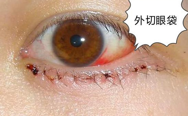 去眼袋術后出現(xiàn)眼瞼外翻是什么原因?怎么修復?