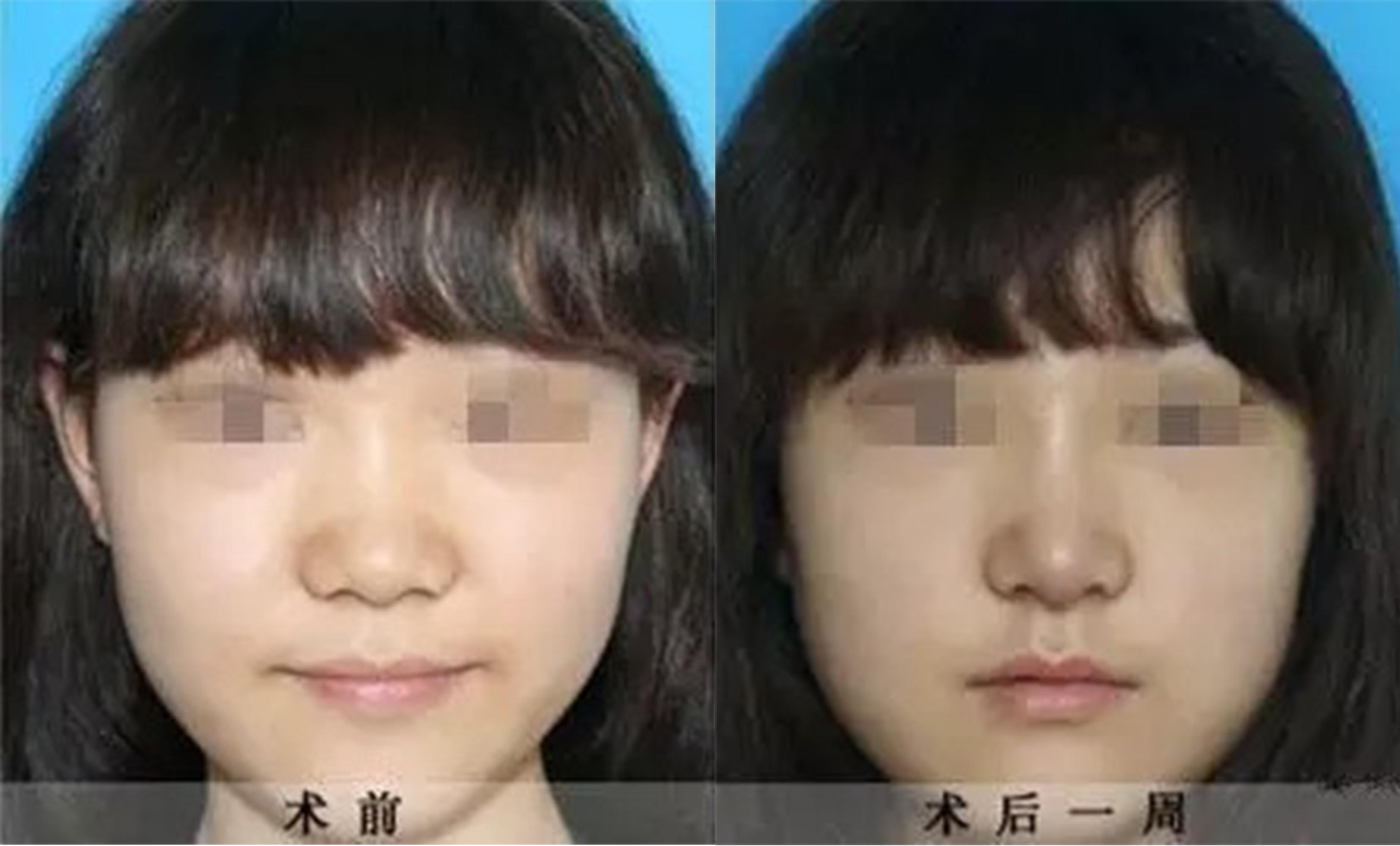 鼻頭、鼻翼縮小