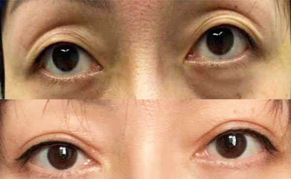 年輕人眼窩凹陷是什么原因?年輕人眼窩凹陷怎樣恢復?
