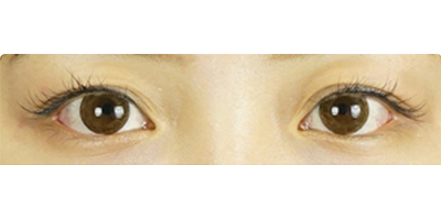 切開(kāi)雙眼皮術(shù)前