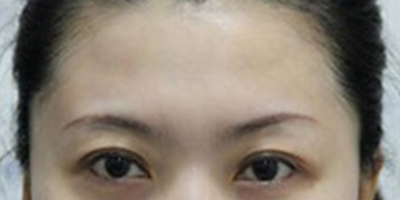 自體脂肪豐太陽穴術后