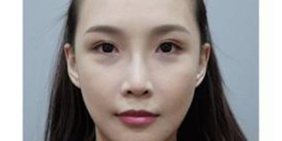 自體真皮隆鼻術后