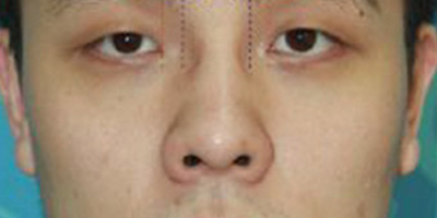 鼻孔矯正術后