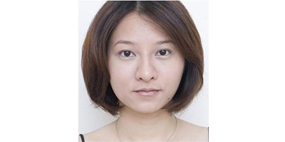 玻尿酸去法令紋術后