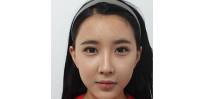 玻尿酸豐面頰術后