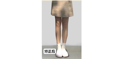 xo型腿矯正術后